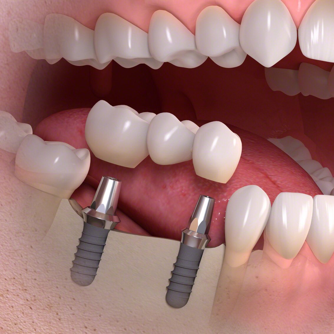 клиника протезирования зубов